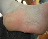 Athlete's Foot